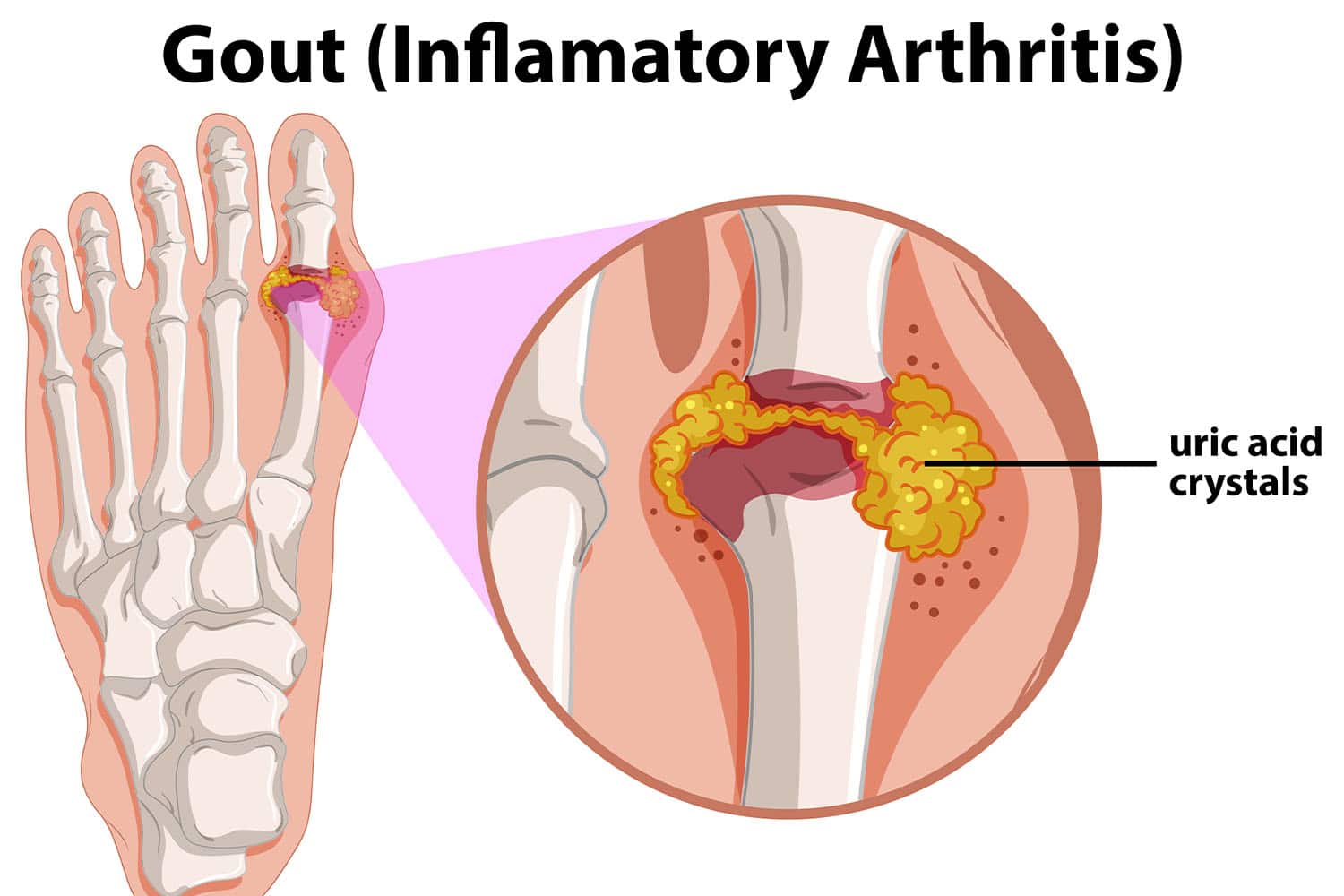 Is Gout an Autoimmune Disease?